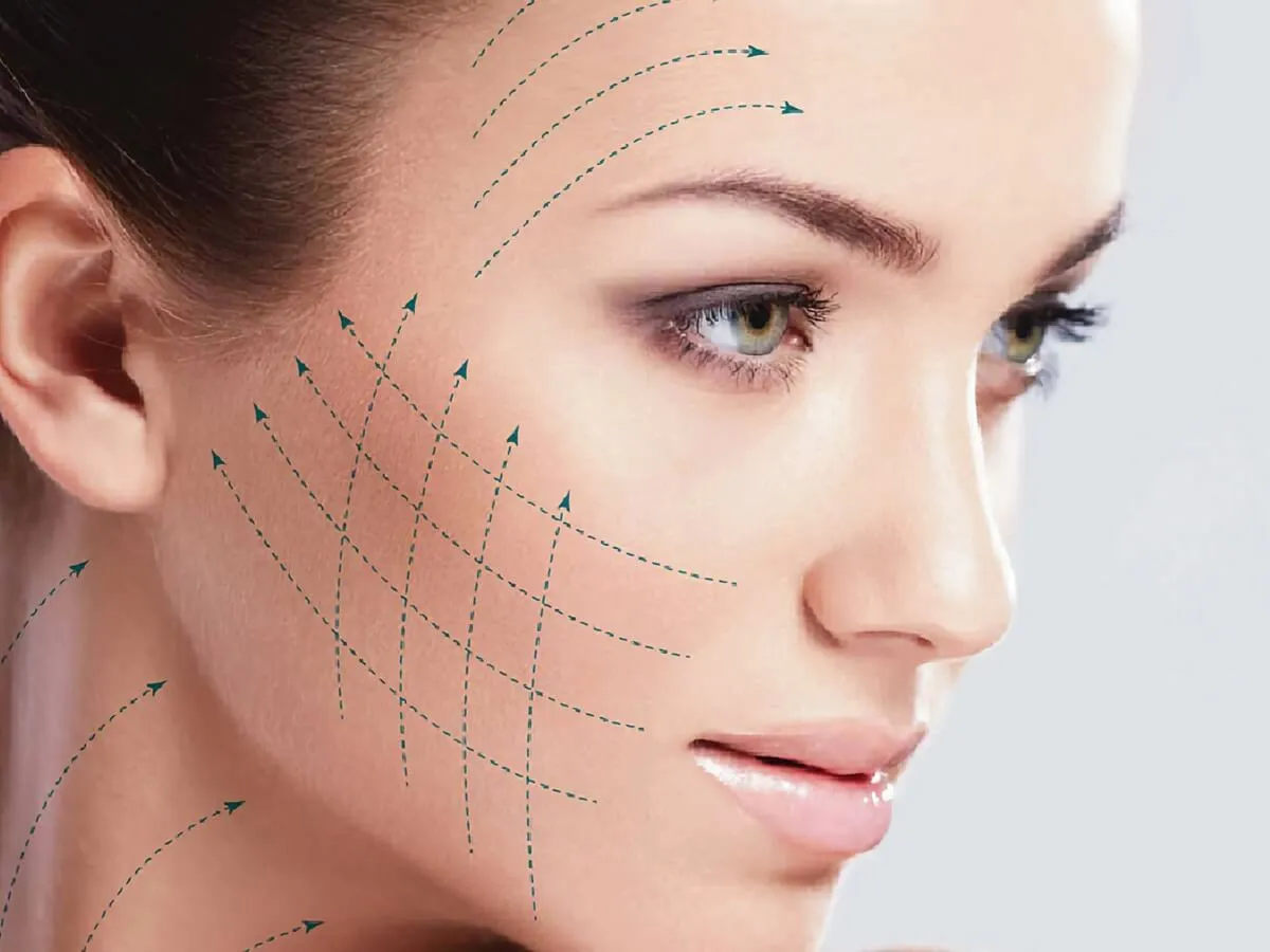 Lifting facial con Hilos Tensores en Juriquilla, Querétaro